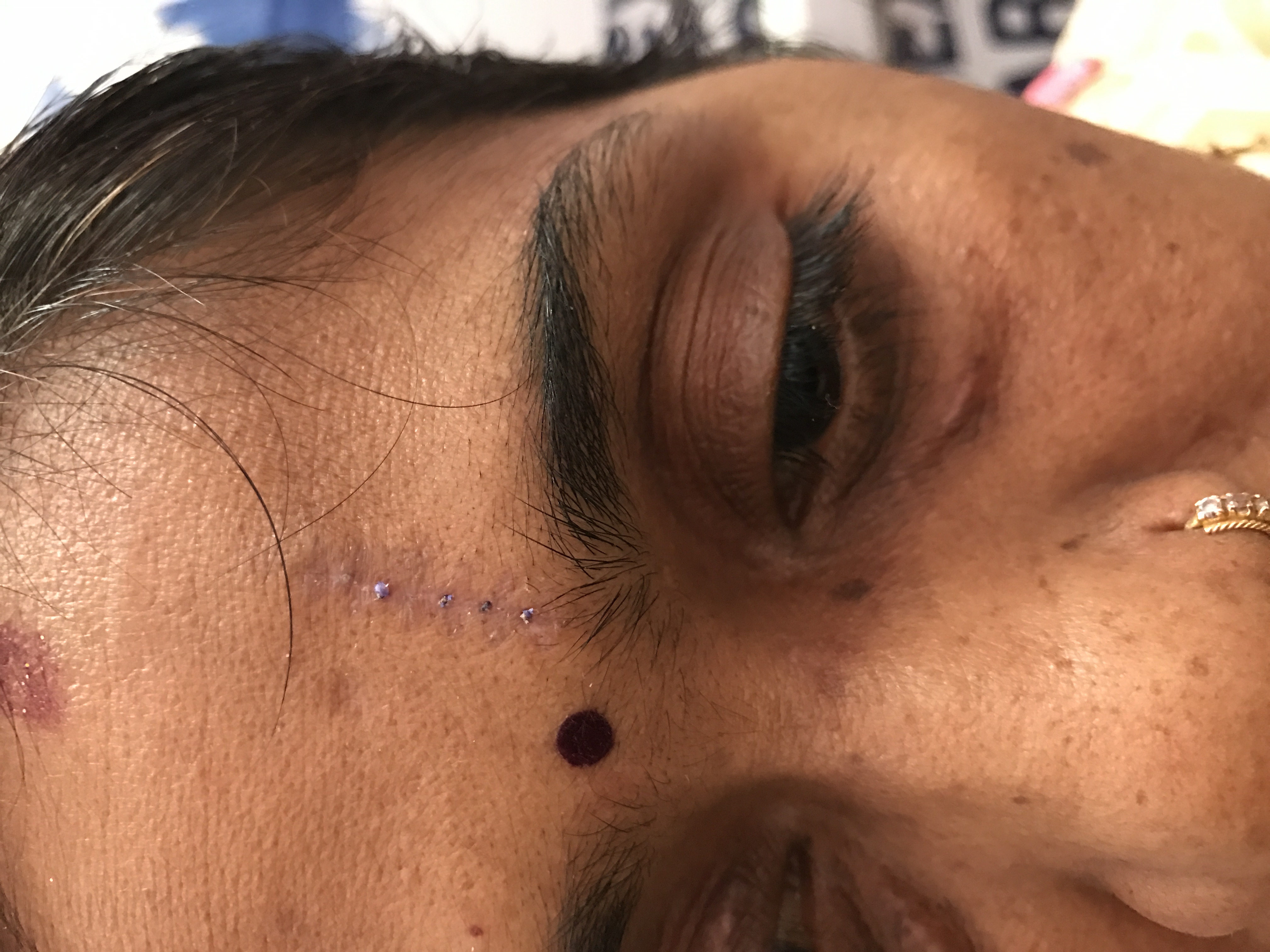 After Traumatic scar reduction — smoother skin after combination therapy