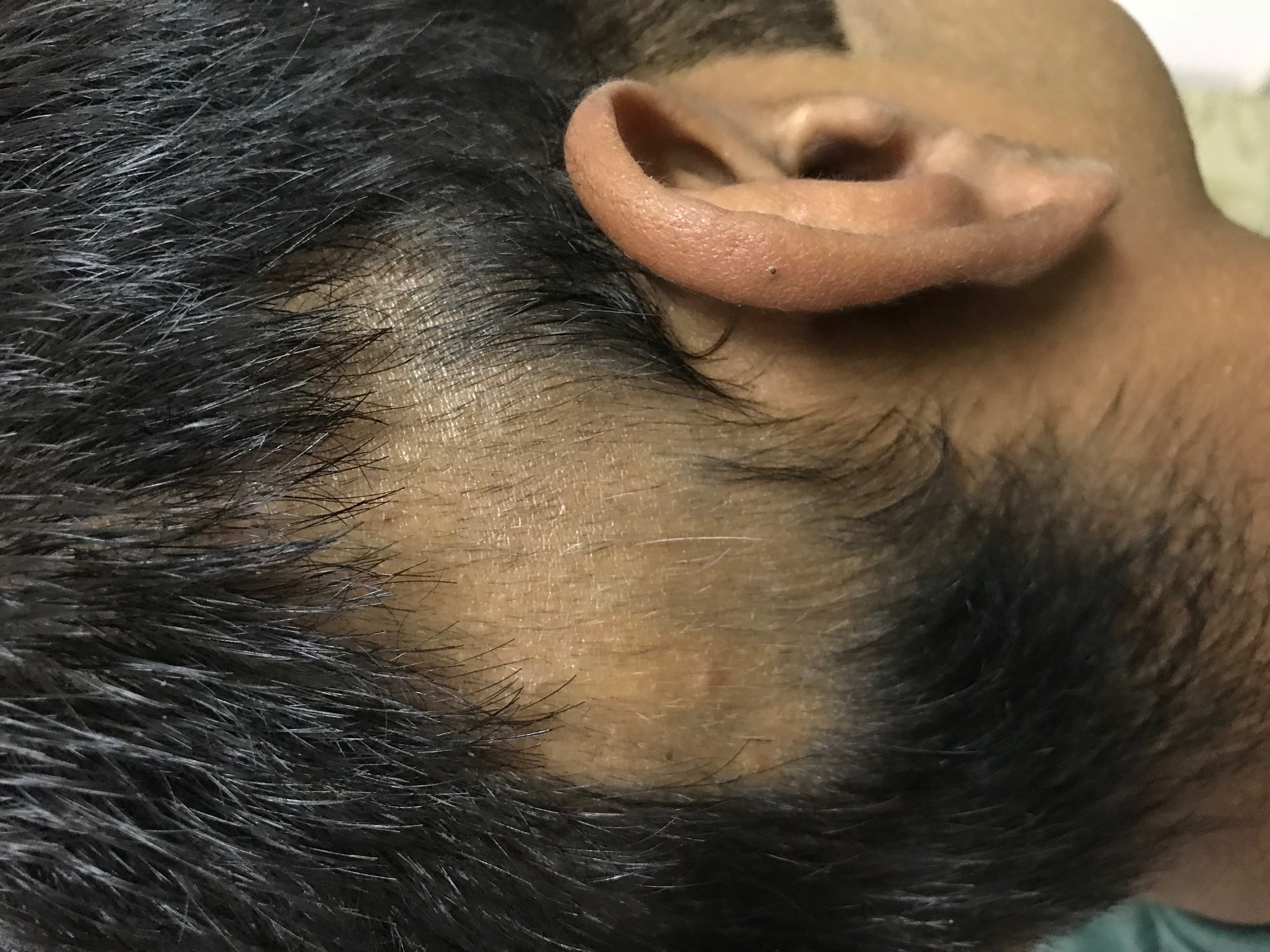After Plantar wart removal — clean excision with smooth recovery