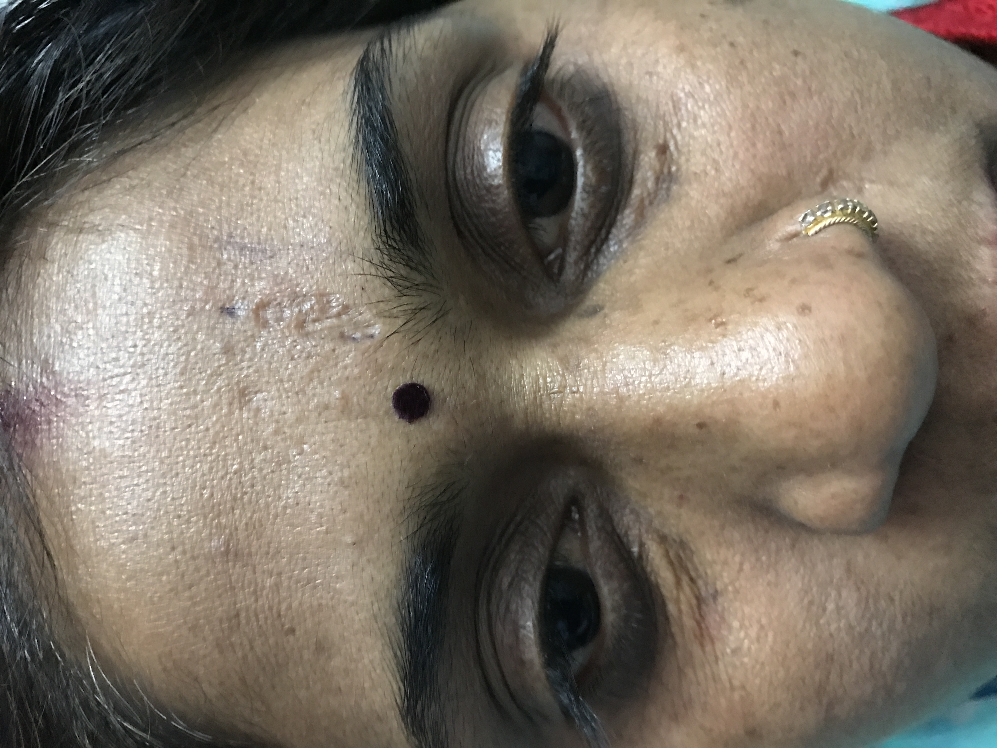Before Traumatic scar reduction — smoother skin after combination therapy