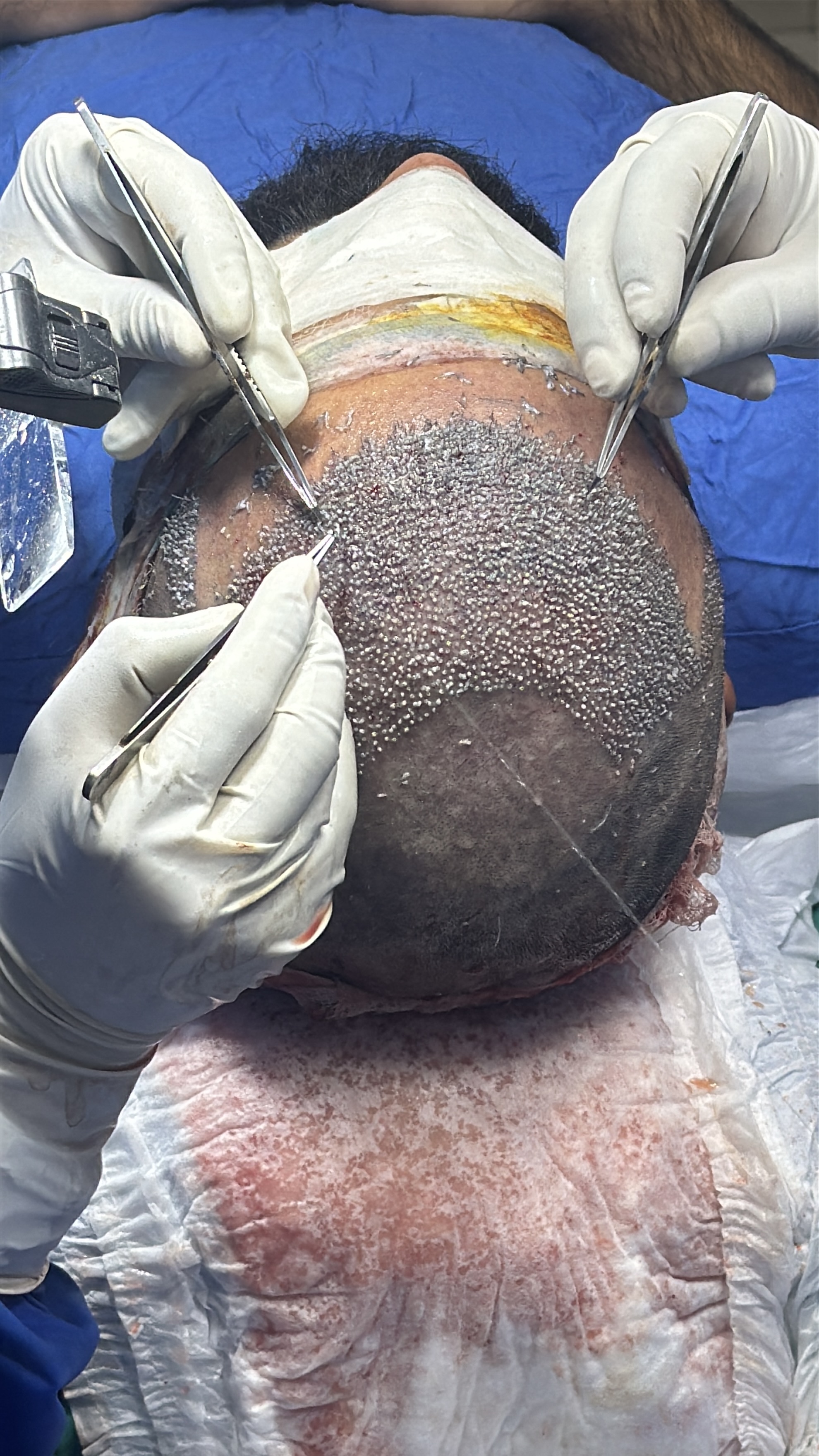 Hair Transplantation