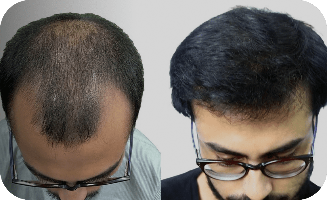 Platelet-Rich Plasma (PRP) Treatment in Jaipur