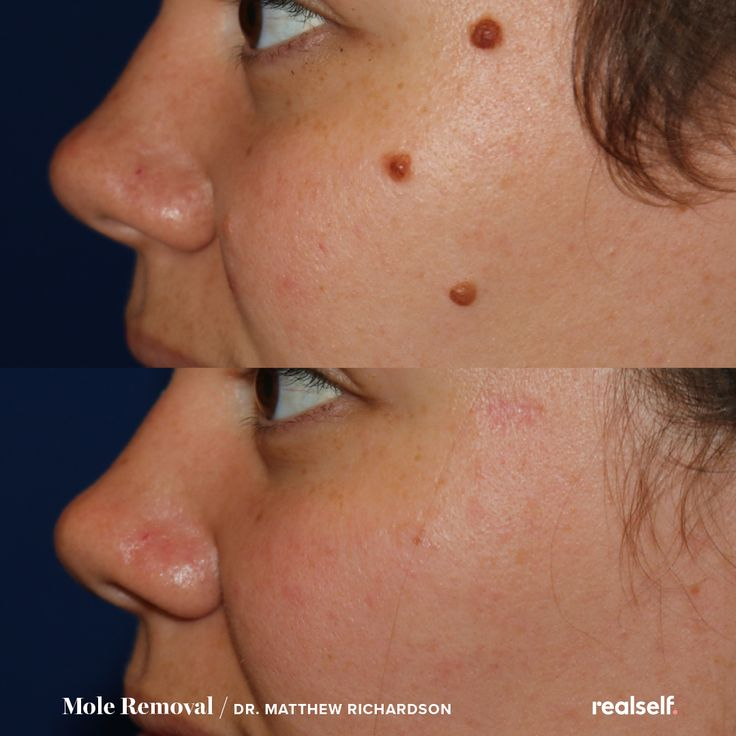 Mole Removal Treatment in Jaipur