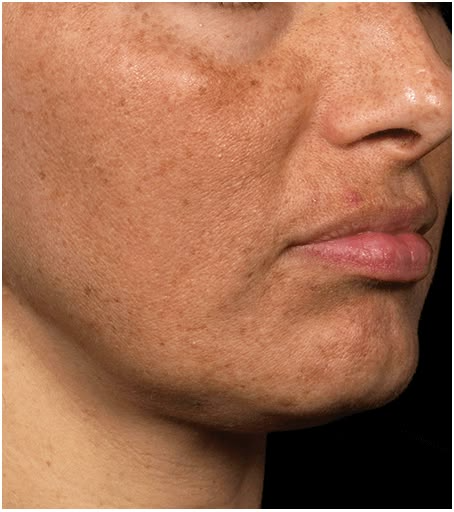 Pigmentation
